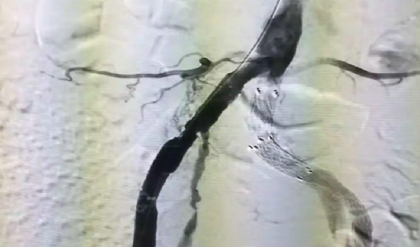 微创介入贯通“生命线”，北京望京医院血管外科高难度双侧动脉重建术